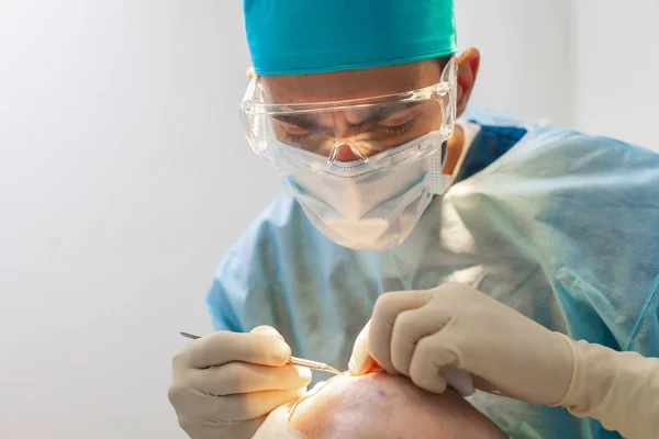 Tratamento da calvície. Transplante de cabelo. Cirurgiões na sala de cirurgia realizar cirurgia de transplante de cabelo. Técnica cirúrgica que move os folículos pilosos de uma parte da cabeça . — Fotografia de Stock