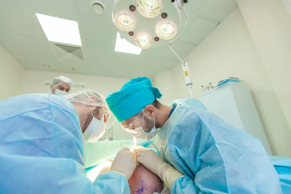 Pengobatan kebotakan. Transplantasi rambut. Ahli bedah di ruang operasi melakukan operasi transplantasi rambut. Teknik bedah yang menggerakkan folikel rambut dari bagian kepala . — Stok Foto