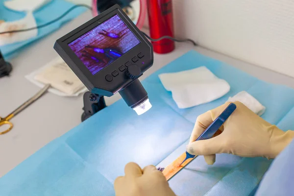 Le médecin au microscope recalcule les follicules pileux. Traitement de calvitie. Une greffe de cheveux. Technique chirurgicale qui déplace les follicules pileux d'une partie de la tête . — Photo