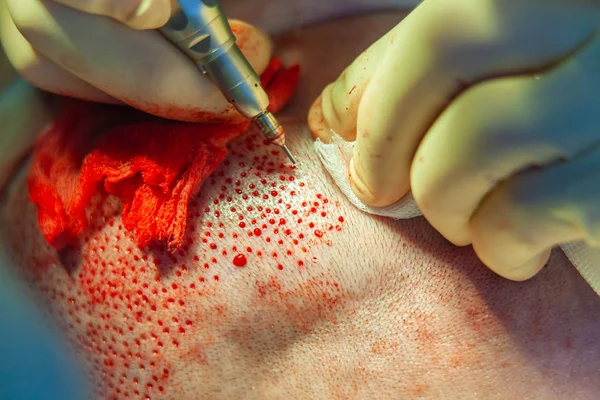 Patients head close-up. Baldness treatment. Hair transplant. Surgeons in the operating room carry out hair transplant surgery. Surgical technique that moves hair follicles from a part of the head. — Stock Photo, Image