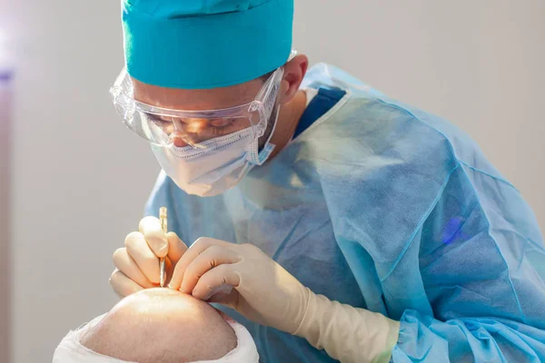 Tratamento da calvície. Transplante de cabelo. Cirurgiões na sala de cirurgia realizar cirurgia de transplante de cabelo. Técnica cirúrgica que move os folículos pilosos de uma parte da cabeça . — Fotografia de Stock