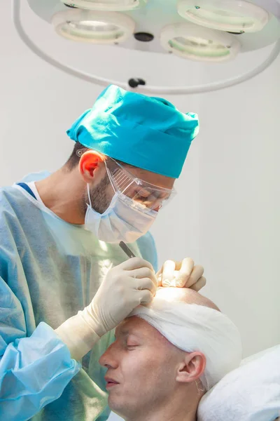 Θεραπεία της φαλάκρα. Μεταμόσχευση μαλλιών. Χειρούργοι στο χειρουργείο διεξάγουν εγχείρηση μεταμόσχευσης μαλλιών. Χειρουργική τεχνική που μετακινεί τα τριχοθυλακίων από ένα μέρος του κεφαλιού. — Φωτογραφία Αρχείου