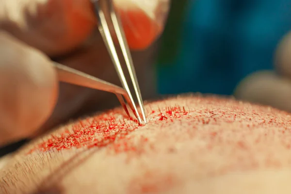 Macrophotographie d'un bulbe capillaire transplanté dans une zone sans poils. Traitement de calvitie. Une greffe de cheveux. Les chirurgiens dans la salle d'opération effectuent une greffe de cheveux. Technique chirurgicale qui bouge — Photo