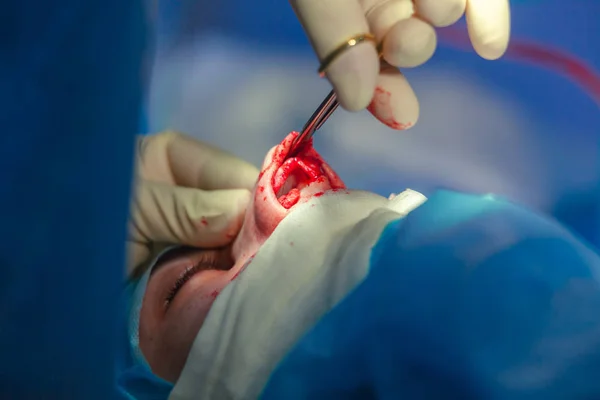 Cirurgião e seu assistente realizando cirurgia estética no nariz na sala de cirurgia do hospital. Reformulação do nariz, aumento. Rinoplastia . — Fotografia de Stock