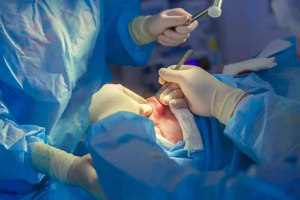 Cirujano y su asistente realizando cirugía estética en la nariz en el quirófano del hospital. Remodelación de la nariz, aumento. Rinoplastia. Martillo . — Foto de Stock