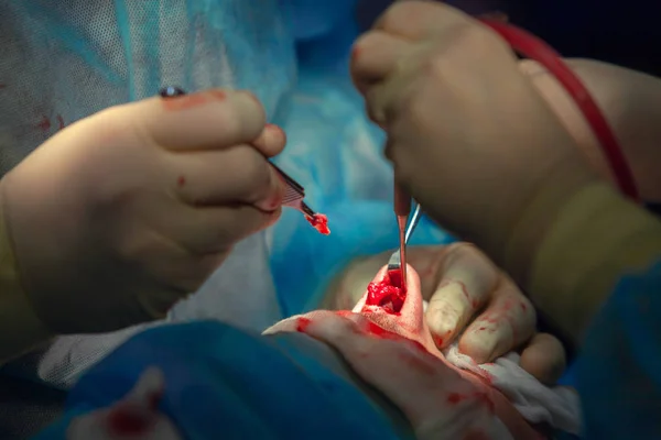 Χειρουργός και ο Βοηθός του εκτέλεση πλαστικής χειρουργικής επέμβασης στη μύτη σε λειτουργικό δωμάτιο νοσοκομείου. Μύτη αναμόρφωση, αυξητική. Ρινοπλαστική. — Φωτογραφία Αρχείου