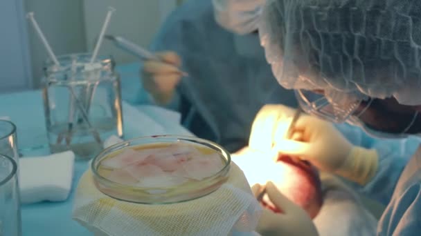 Tratamiento de la calvicie. Trasplante de cabello. Los cirujanos en el quirófano llevan a cabo una cirugía de trasplante de cabello. Técnica quirúrgica que mueve los folículos pilosos de una parte de la cabeza . — Vídeo de stock