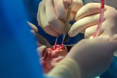 Cerrah ve hastane ameliyathane burnuna estetik ameliyat asistanı. Burnun yeniden şekillendirilmesi, büyütme. Burun estetiği.