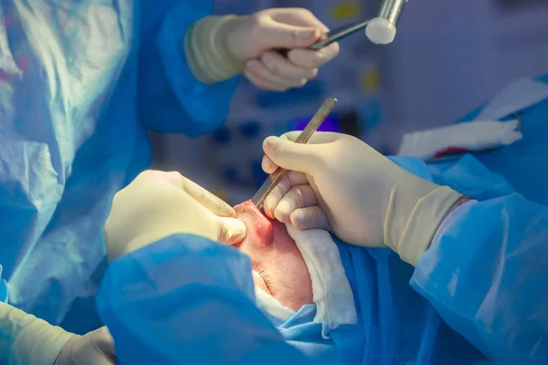 Cirurgião e seu assistente realizando cirurgia estética no nariz na sala de cirurgia do hospital. Reformulação do nariz, aumento. Rinoplastia. Martelo . — Fotografia de Stock