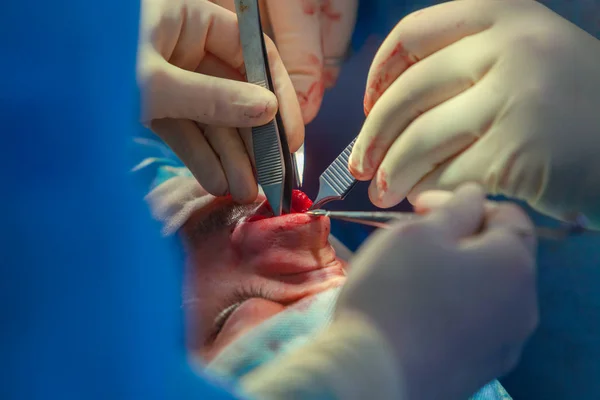 Chirurg und sein Assistent bei Schönheitsoperationen an der Nase im Operationssaal des Krankenhauses. Nasenumformung, Augmentation. Nasenkorrektur. — Stockfoto