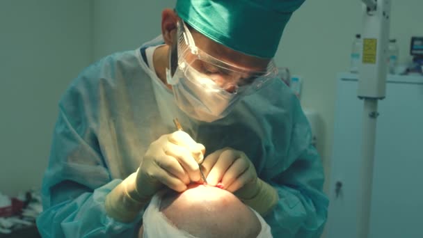 Pengobatan kebotakan. Transplantasi rambut. Ahli bedah di ruang operasi melakukan operasi transplantasi rambut. Teknik bedah yang menggerakkan folikel rambut dari bagian kepala . — Stok Video