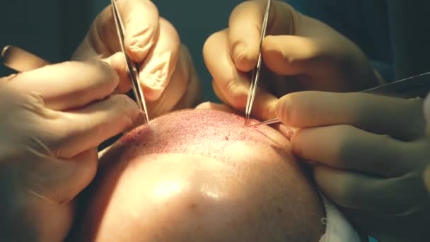 はげ治療。毛髪移植手術室の外科医は毛髪移植手術を行う。頭の一部から毛包を動かす外科的手法. — ストック動画