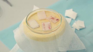 Fincan yakın çekim saç kökleri. Kellik tedavisi. Saç ekimi. Ameliyathanedeki cerrahlar saç nakli ameliyatı gerçekleştirin. Saç köklerini bir parçadan hareket ettiren cerrahi teknik.