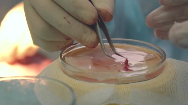 Folículos de cabelo na taça close-up. Tratamento da calvície. Transplante de cabelo. Cirurgiões na sala de cirurgia realizar cirurgia de transplante de cabelo. Técnica cirúrgica que move os folículos pilosos de uma parte de . — Vídeo de Stock