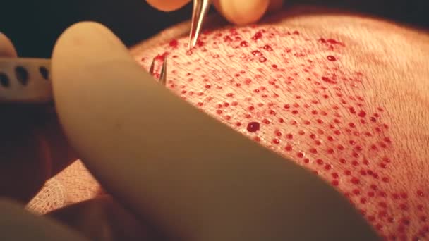 Patients head close-up. Baldness treatment. Hair transplant. Surgeons in the operating room carry out hair transplant surgery. Surgical technique that moves hair follicles from a part of the head. — Stock Video