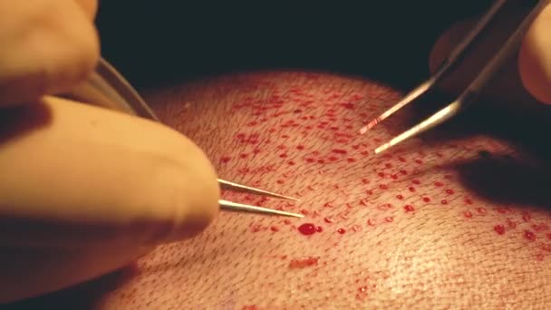 Patienter huvudet närbild. Skallighet behandling. Hårtransplantation. Kirurger i operationssalen utför hår transplantationskirurgi. Kirurgisk teknik som flyttar hårsäckarna från en del av huvudet. — Stockvideo