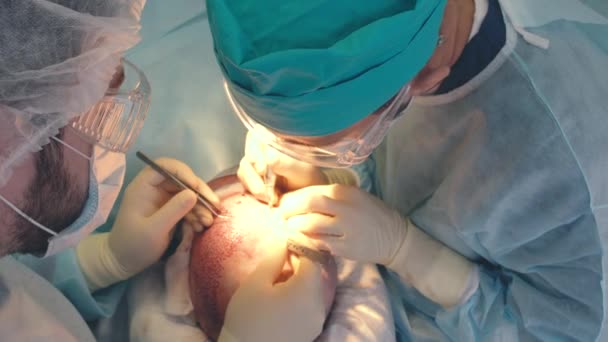 Tratamiento de la calvicie. Trasplante de cabello. Los cirujanos en el quirófano llevan a cabo una cirugía de trasplante de cabello. Técnica quirúrgica que mueve los folículos pilosos de una parte de la cabeza . — Vídeo de stock