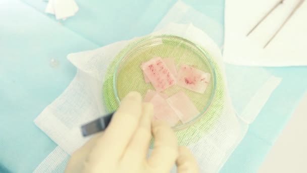 Hair follicles in the Cup close-up. Baldness treatment. Hair transplant. Surgeons in the operating room carry out hair transplant surgery. Surgical technique that moves hair follicles from a part of. — Stock Video