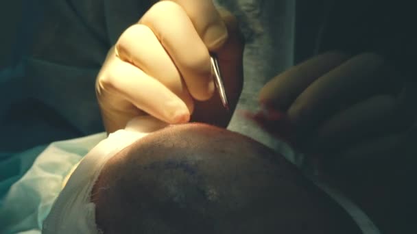 Kellik tedavisi. Saç ekimi. Ameliyathanedeki cerrahlar saç nakli ameliyatı gerçekleştirin. Saç köklerini başın bir kısmından hareket ettiren cerrahi teknik. — Stok video