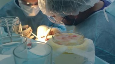 Kellik tedavisi. Saç ekimi. Ameliyathanedeki cerrahlar saç nakli ameliyatı gerçekleştirin. Saç köklerini başın bir kısmından hareket ettiren cerrahi teknik.