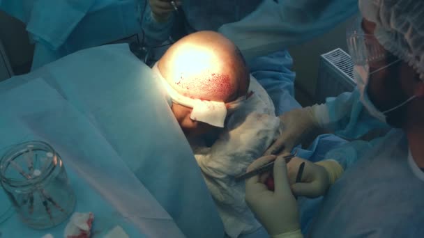 Tratamiento de la calvicie. Trasplante de cabello. Los cirujanos en el quirófano llevan a cabo una cirugía de trasplante de cabello. Técnica quirúrgica que mueve los folículos pilosos de una parte de la cabeza . — Vídeo de stock
