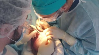 Kellik tedavisi. Saç ekimi. Ameliyathanedeki cerrahlar saç nakli ameliyatı gerçekleştirin. Saç köklerini başın bir kısmından hareket ettiren cerrahi teknik.