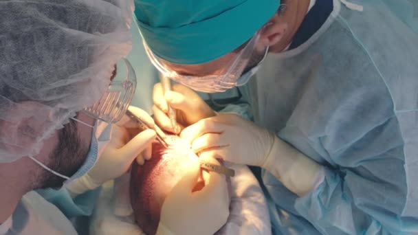 Θεραπεία της φαλάκρα. Μεταμόσχευση μαλλιών. Χειρούργοι στο χειρουργείο διεξάγουν εγχείρηση μεταμόσχευσης μαλλιών. Χειρουργική τεχνική που μετακινεί τα τριχοθυλακίων από ένα μέρος του κεφαλιού. — Αρχείο Βίντεο
