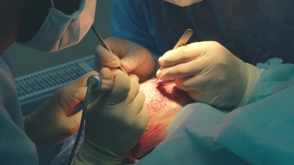 Glatzenbehandlung. Haartransplantation. Chirurgen im Operationssaal führen Haartransplantationen durch. Chirurgische Technik, die Haarfollikel aus einem Teil des Kopfes entfernt. — Stockvideo