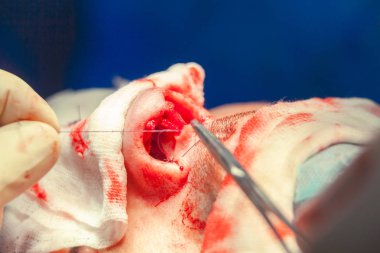 Cerrah ve hastane ameliyathane burnuna estetik ameliyat asistanı. Burnun yeniden şekillendirilmesi, büyütme. Burun estetiği.