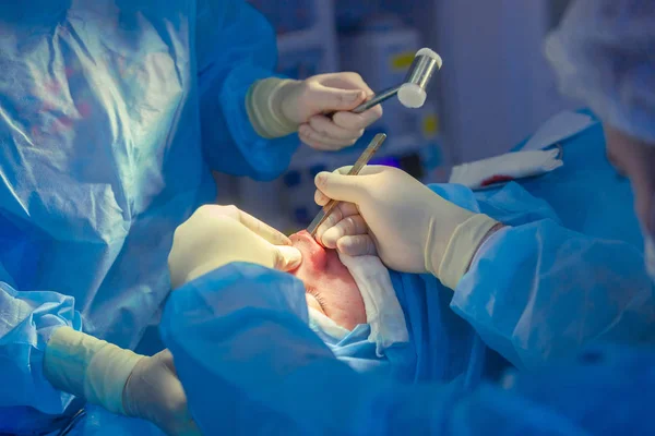 Cirujano y su asistente realizando cirugía estética en la nariz en el quirófano del hospital. Remodelación de la nariz, aumento. Rinoplastia. Martillo . — Foto de Stock