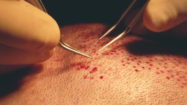 患者はクローズアップします。はげ治療。毛髪移植手術室の外科医は毛髪移植手術を行う。頭の一部から毛包を動かす外科的手法. — ストック動画