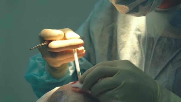 Péče o plešatost. Transplantace vlasů. Chirurgové v operačním sále provádějí transplantaci vlasů. Chirurgická technika, která přesouvá vlasový folikles z části hlavy. — Stock video