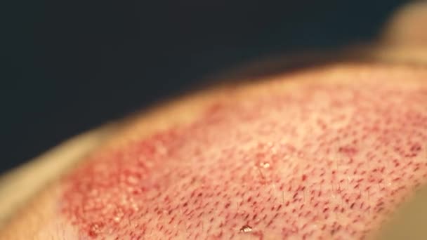 Macrofotografía de un bulbo capilar trasplantado en una zona sin pelo. Tratamiento de la calvicie. Trasplante de cabello. Los cirujanos en el quirófano llevan a cabo una cirugía de trasplante de cabello. Técnica quirúrgica que se mueve . — Vídeos de Stock