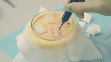 Fincan yakın çekim saç kökleri. Kellik tedavisi. Saç ekimi. Ameliyathanedeki cerrahlar saç nakli ameliyatı gerçekleştirin. Saç köklerini bir parçadan hareket ettiren cerrahi teknik.