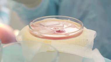 Fincan yakın çekim saç kökleri. Kellik tedavisi. Saç ekimi. Ameliyathanedeki cerrahlar saç nakli ameliyatı gerçekleştirin. Saç köklerini bir parçadan hareket ettiren cerrahi teknik.