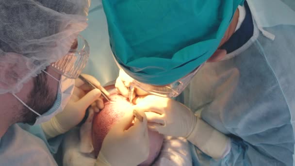 Θεραπεία της φαλάκρα. Μεταμόσχευση μαλλιών. Χειρούργοι στο χειρουργείο διεξάγουν εγχείρηση μεταμόσχευσης μαλλιών. Χειρουργική τεχνική που μετακινεί τα τριχοθυλακίων από ένα μέρος του κεφαλιού. — Αρχείο Βίντεο