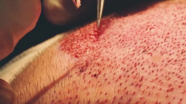 Macrofotografía de un bulbo capilar trasplantado en una zona sin pelo. Tratamiento de la calvicie. Trasplante de cabello. Los cirujanos en el quirófano llevan a cabo una cirugía de trasplante de cabello. Técnica quirúrgica que se mueve . — Vídeo de stock