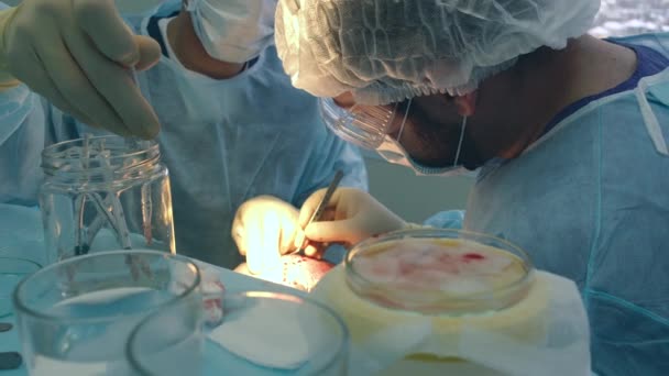 Tratamiento de la calvicie. Trasplante de cabello. Los cirujanos en el quirófano llevan a cabo una cirugía de trasplante de cabello. Técnica quirúrgica que mueve los folículos pilosos de una parte de la cabeza . — Vídeo de stock