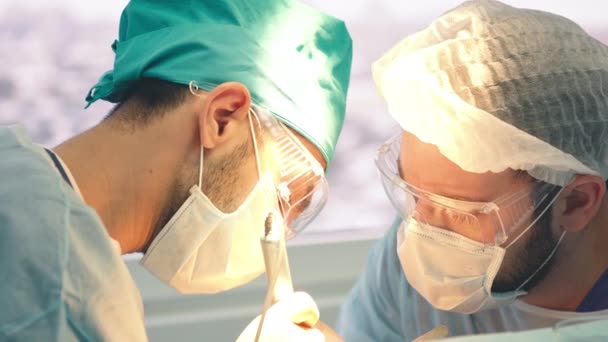 Tratamento da calvície. Transplante de cabelo. Cirurgiões na sala de cirurgia realizar cirurgia de transplante de cabelo. Técnica cirúrgica que move os folículos pilosos de uma parte da cabeça . — Vídeo de Stock