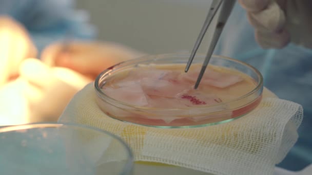 Hair follicles in the Cup close-up. Baldness treatment. Hair transplant. Surgeons in the operating room carry out hair transplant surgery. Surgical technique that moves hair follicles from a part of. — Stock Video