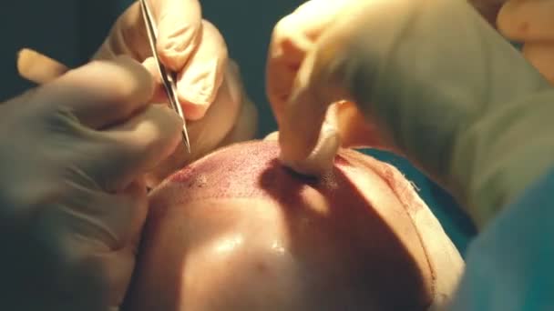 Kaalheid behandeling. Haartransplantatie. Chirurgen in de operatiekamer voeren haartransplantatiechirurgie uit. Chirurgische techniek die haarfollikels van een deel van het hoofd beweegt. — Stockvideo