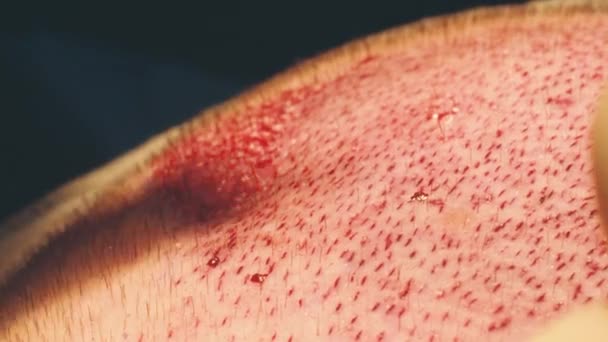 Macrofotografía de un bulbo capilar trasplantado en una zona sin pelo. Tratamiento de la calvicie. Trasplante de cabello. Los cirujanos en el quirófano llevan a cabo una cirugía de trasplante de cabello. Técnica quirúrgica que se mueve . — Vídeo de stock