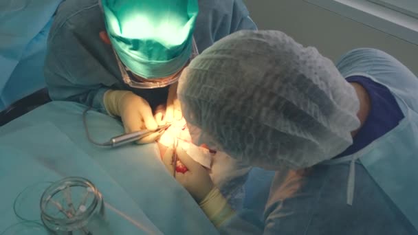 Kaalheid behandeling. Haartransplantatie. Chirurgen in de operatiekamer voeren haartransplantatiechirurgie uit. Chirurgische techniek die haarfollikels van een deel van het hoofd beweegt. — Stockvideo