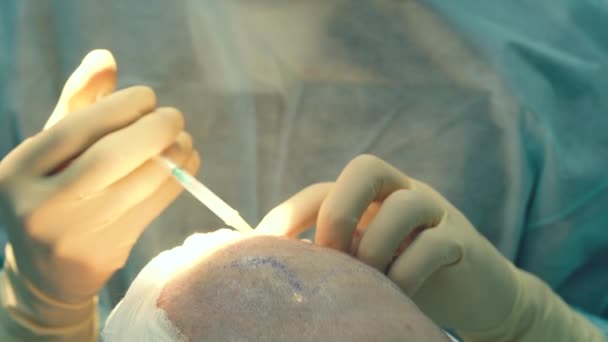 秃头治疗。头发移植手术室的外科医生进行头发移植手术。从头部部分移动毛囊的外科技术. — 图库视频影像