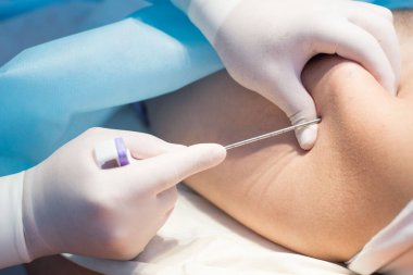 Uzun iğne kullanan bir onkolog, çocuklarda lösemi, Ewing sarkomu ve kemik iltihabı hastalığı teşhisi koymak için ileumu delmiş. Kemik kanseri teşhisi Pediatrik onkoloji