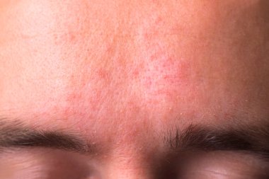 allergic spots in a specific area of the face. Treatment gets wet eczema, psoriasis, streptoderma clipart