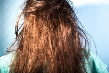 Kirli, yağlı, dağınık saçlı ve kafa derisi sorunlu bir kızın portresi. Mavi arka planda. Dermatolojik saç hastalığı, kepek, deri iltihabı, egzama, yağlı saç. Kötü saç şampuanı..