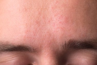 allergic spots in a specific area of the face. Treatment gets wet eczema, psoriasis, streptoderma clipart