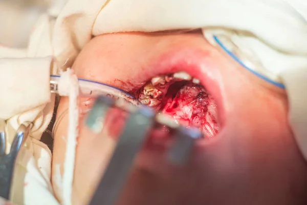 Cerrahi Dişçilik Çocuklarda Ağız Cerrahi Tedavisiyle Tedavi Edilir Operasyonun Aşamalarından — Stok fotoğraf