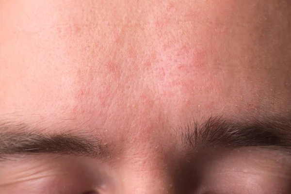 Yüzün belirli bir bölgesinde alerjik noktalar var. Tedavi ıslanır egzama, sedef, streptoderma